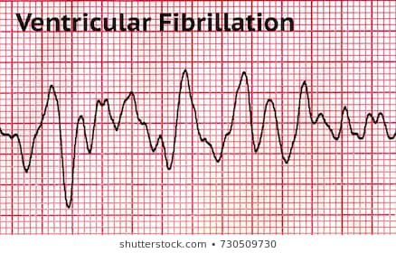 ventricular-fibrillation-vf-condition-which-260nw-730509730